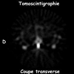 Tomoscintigraphie - Coupe transverse