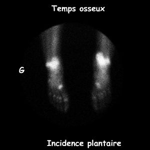 Pieds incidence plantaire