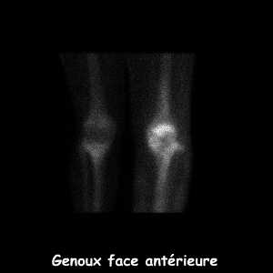 Temps osseux - Genoux face antérieure