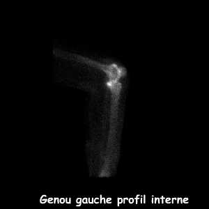 Temps osseux - Genou gauche profil interne