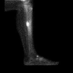 Temps osseux - Profil interne tibia gauche