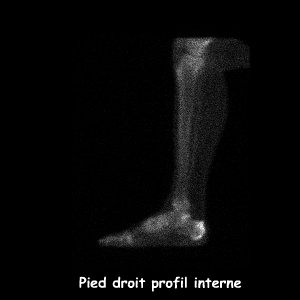 Temps osseux - Profil interne pied droit