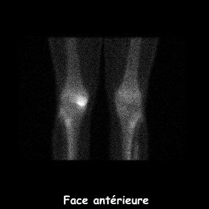 Temps osseux - Genoux face antérieure