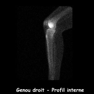 Temps osseux - Genou droit profil interne