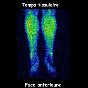 Jambes - Temps tissulaire