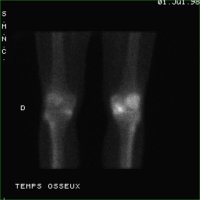 Temps osseux