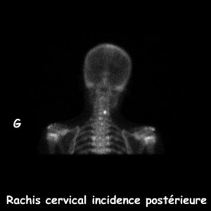 Rachis cervical incidence postérieure