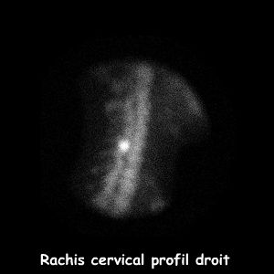 Rachis cervical - Profil droit