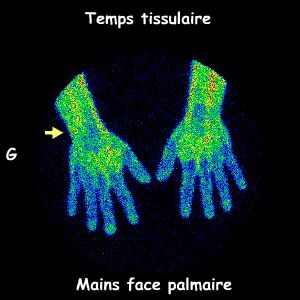 Mains - Temps tissulaire