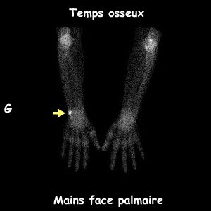 Mains - Temps osseux