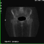 Temps osseux 