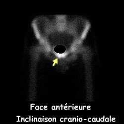 Bassin - Face antérieure incidence cranio-caudale