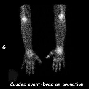 Coudes avant-bras en pronation