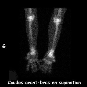 Coudes avant-bras en supination