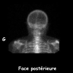 Face postérieure