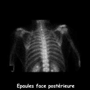 Epaules - Face postérieure