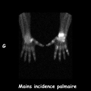 Mains incidence palmaire