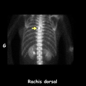 Rachis dorsal