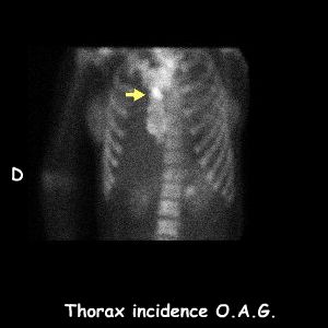 Thorax incidence O.A.G.