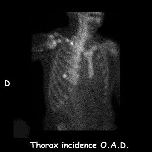 Thorax incidence O.A.D.