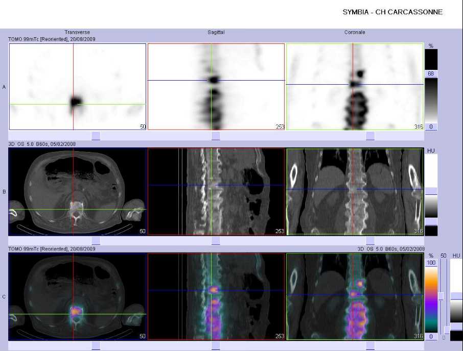 Spondylite condensante thoracique