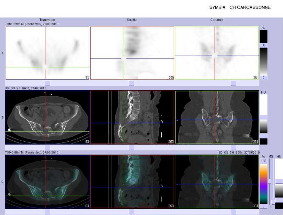 kyste arachnoïdien du sacrum