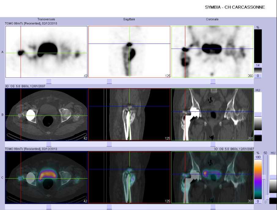 Calcifications péri-prothétiques