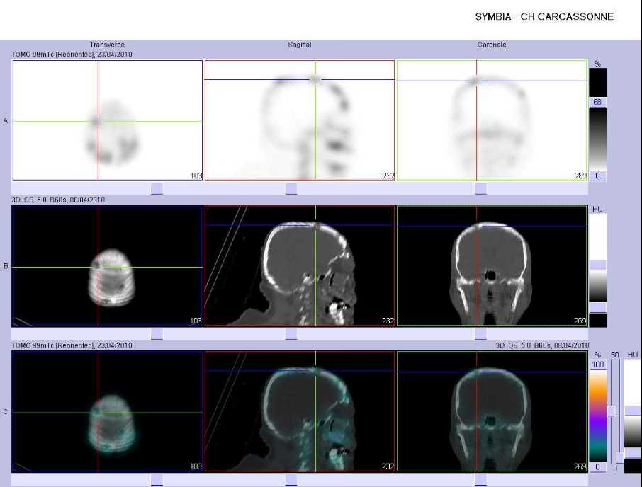 Multiples images d'ostéolyse du crâne