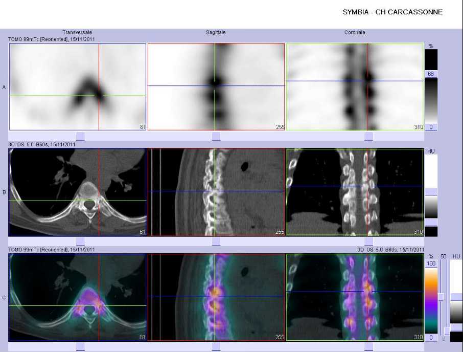 Atteinte inflammatoire des articulations costo-vertébrales