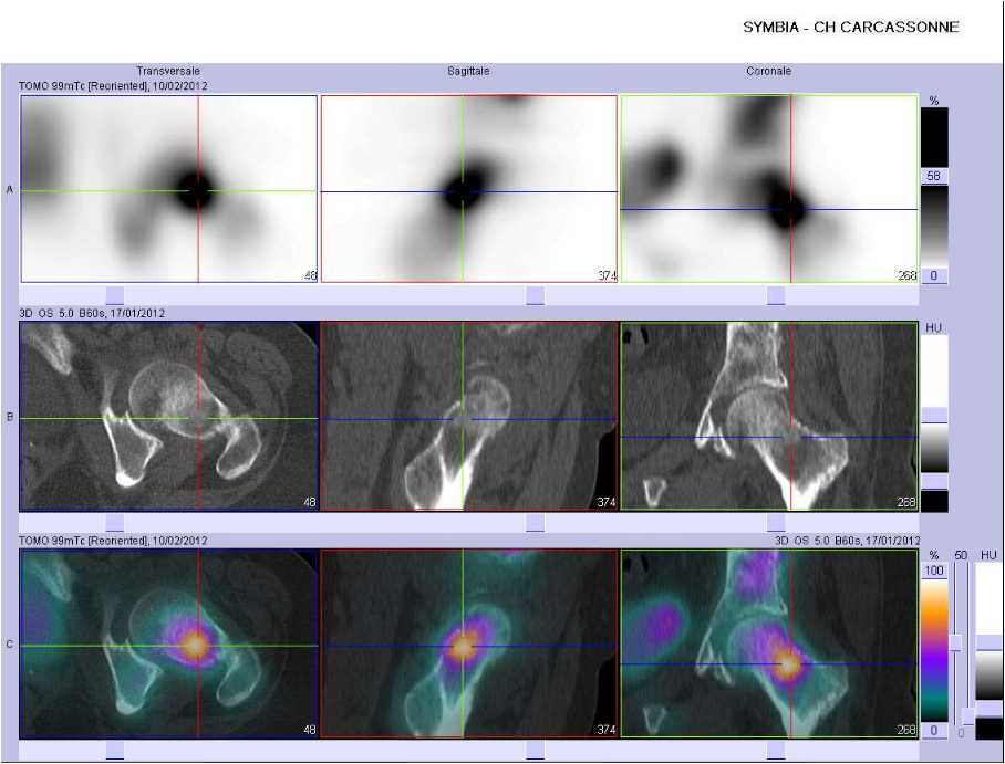 Métastases ostéolytiques de l'extrémité supérieure du fémur gauche