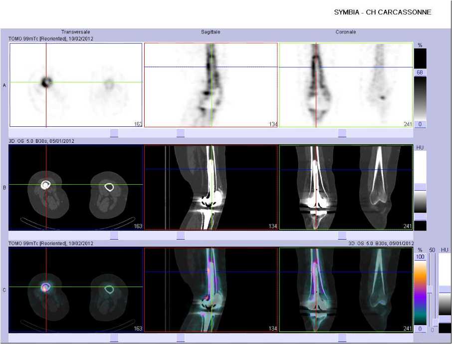 Aspect évocateur d'un descellement infectieux de la prothèse totale de genou droit