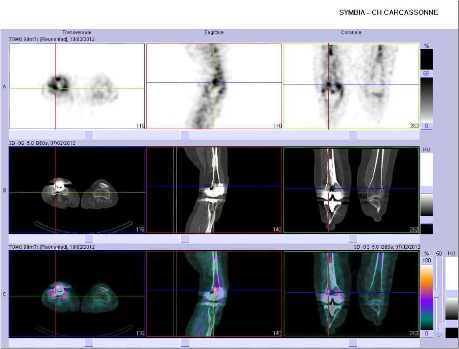 Infection sur prothèse de genou droit