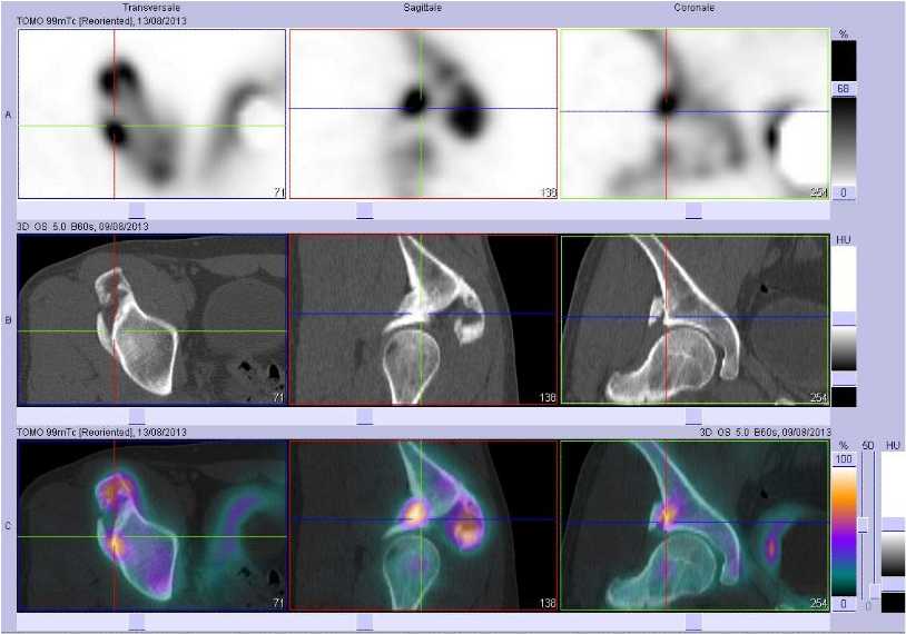 Ossifications musculo tendineuses sus et latéro cotyloïdiennes droites