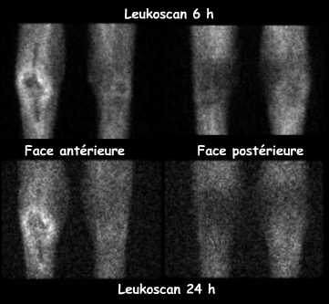 Scintigraphie aux anticorps antigranulocytes marqués (Leukoscan)