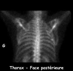 Cliché centré sur le thorax