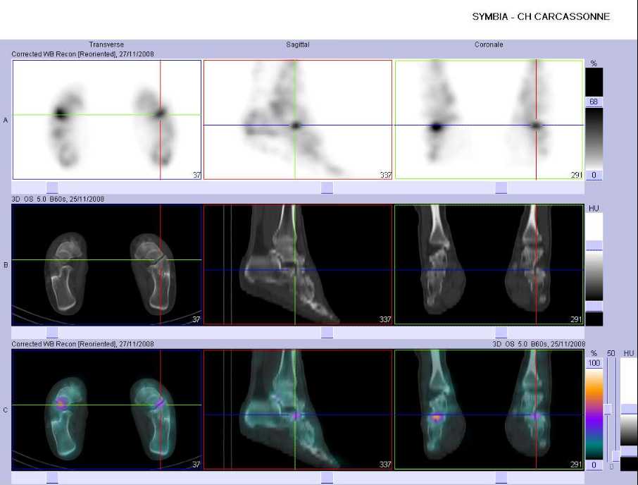 Pathologie microtraumatique médiotarsienne gauche