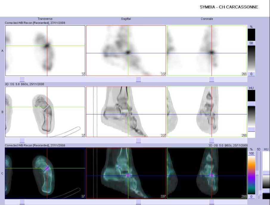 Pathologie microtraumatique médiotarsienne gauche